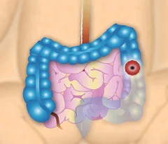 an illustration of a stoma
