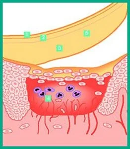 a drawing of how DuoDERM® Dressings work