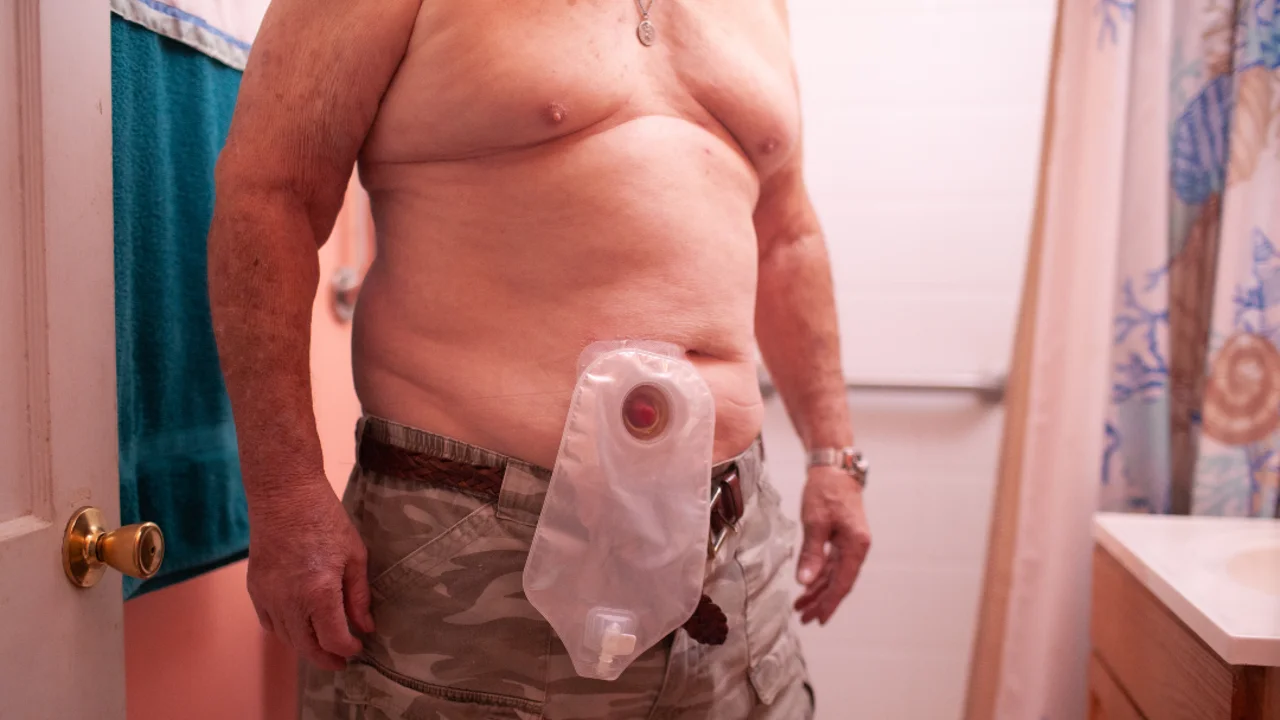 Una foto di una persona che indossa una sacca per stomia.
