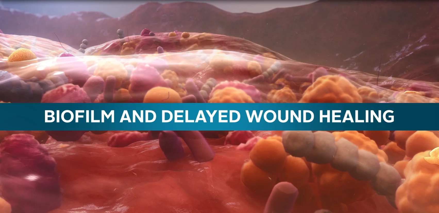 víťazstvo v boji proti ranám, ktoré sa liečia s AQUACEL ™ Ag Advantage